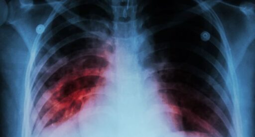 Chest x-ray showing mycobacterium tuberculosis infection